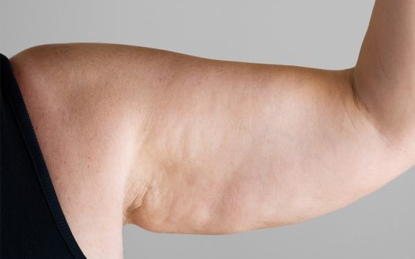 قاتل سلولیت چیست؟ چگونه از شر سلولیت خلاص شویم؟