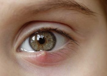 چه زمانی برای گل مژه به پزشک مراجعه کنم؟ درمان انواع جوش چشم
