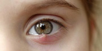 چه زمانی برای گل مژه به پزشک مراجعه کنم؟ درمان انواع جوش چشم