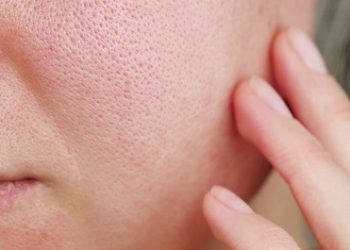 مراقبت از پوست چرب + اطلاعات کامل در مورد نگهداری از انواع پوست چرب