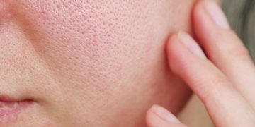 مراقبت از پوست چرب + اطلاعات کامل در مورد نگهداری از انواع پوست چرب