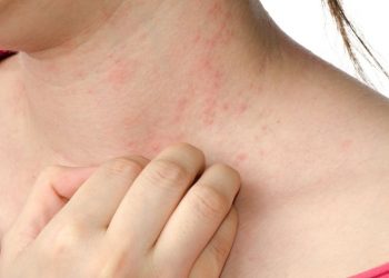 دلایل ایجاد شدن جوش در ناحیه گردن و روش های درمان مشکلات پوستی گردن