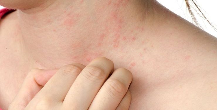 دلایل ایجاد شدن جوش در ناحیه گردن و روش های درمان مشکلات پوستی گردن