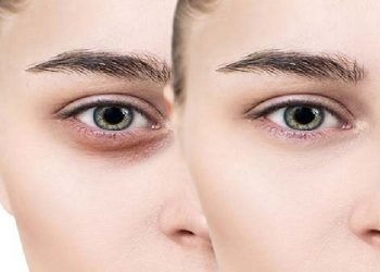 کربوکسی تراپی زیر چشم؛ بررسی هزینهها، عوارض و مزایا