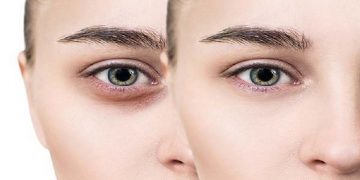 کربوکسی تراپی زیر چشم؛ بررسی هزینه‌ها، عوارض و مزایا