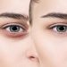 کربوکسی تراپی زیر چشم؛ بررسی هزینهها، عوارض و مزایا