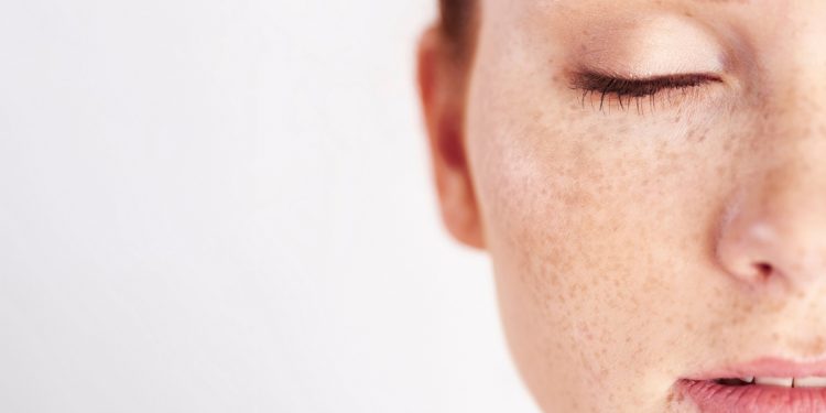 لکه پوست چیست؟ + علائم و درمان انواع لک پوست