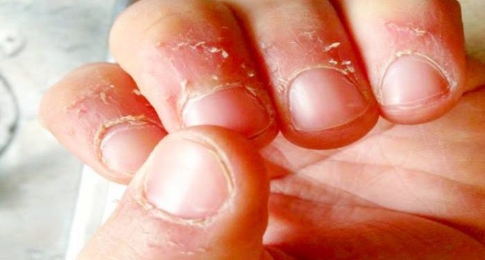 درمان پوسته پوسته شدن اطراف ناخن