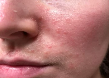 کهیر صورت؛ علائم، دلایل و روش درمان سریع خانگی