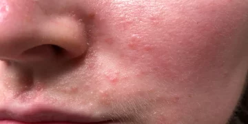 کهیر صورت؛ علائم، دلایل و روش درمان سریع خانگی