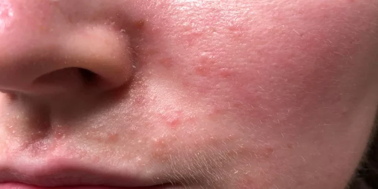 کهیر صورت؛ علائم، دلایل و روش درمان سریع خانگی