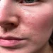کهیر صورت؛ علائم، دلایل و روش درمان سریع خانگی