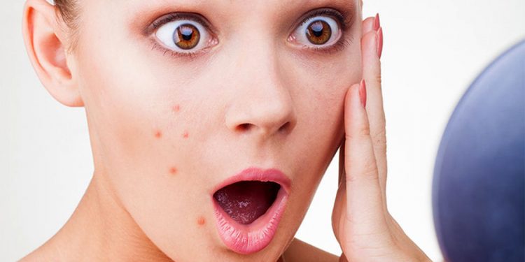 لوسیون خانگی بسازید! روش تهیه لوسیون خانگی برای انواع پوستهای چرب و مستعد آکنه