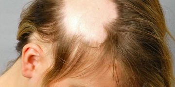 قارچ سر چیست؟