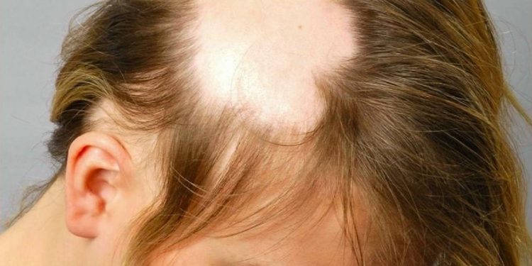 قارچ سر چیست؟