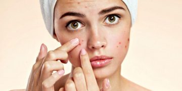 علت و درمان جوش بعد از اصلاح صورت