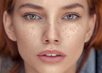 لک صورت: علل و راههای درمان