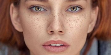 لک‌ صورت: علل و راه‌های درمان 