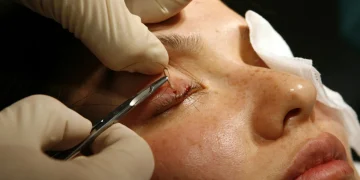 کاشت مژه: روشی برای زیبایی و ترمیم