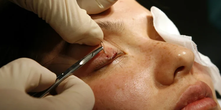 کاشت مژه: روشی برای زیبایی و ترمیم