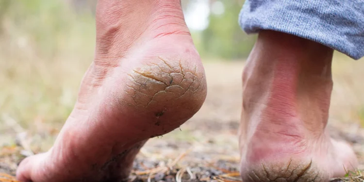 راهکارهای خانگی مؤثر برای درمان ترک پا