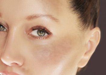 لکهای پوستی صورت: انواع، علل و راههای درمان