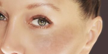 لک‌های پوستی صورت: انواع، علل و راه‌های درمان