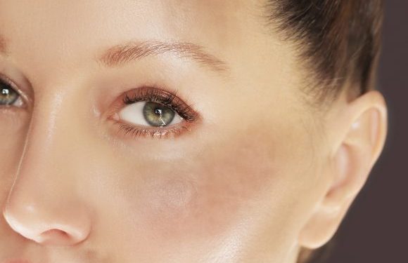 لکهای پوستی صورت: انواع، علل و راههای درمان